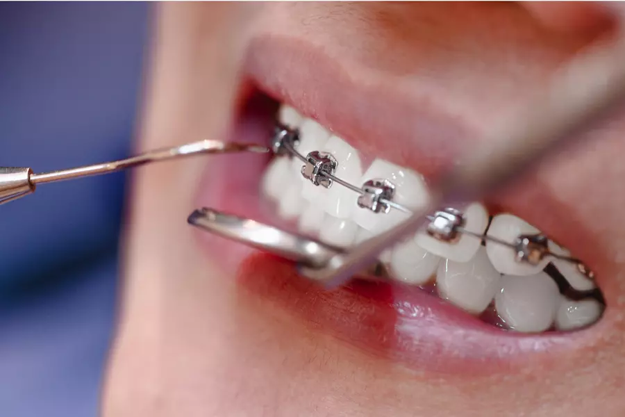  Orthodontic Treatment: Straighten Your Smile with Expert Orthodontic Care