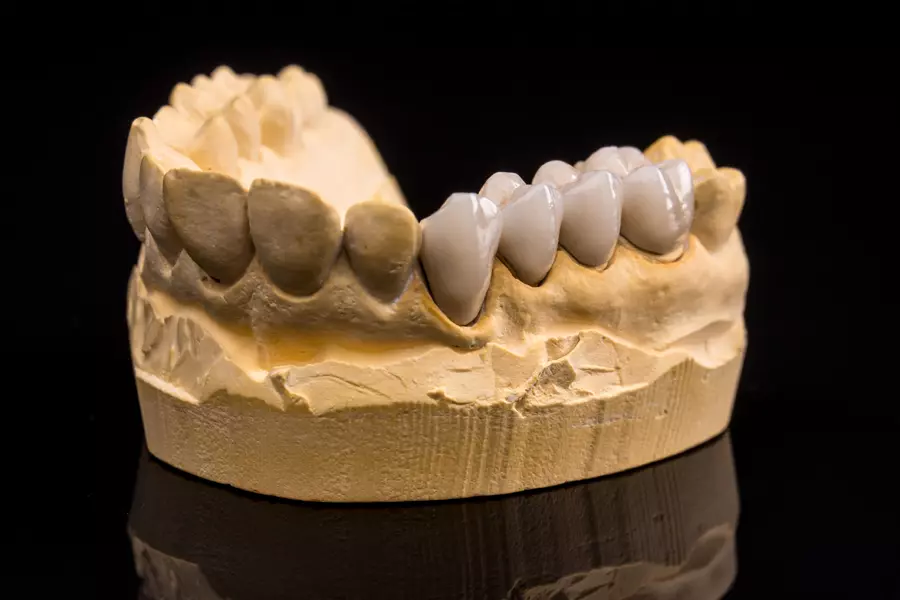  Dental Crowns: Restore the Strength, Function, and Beauty of Your Smile