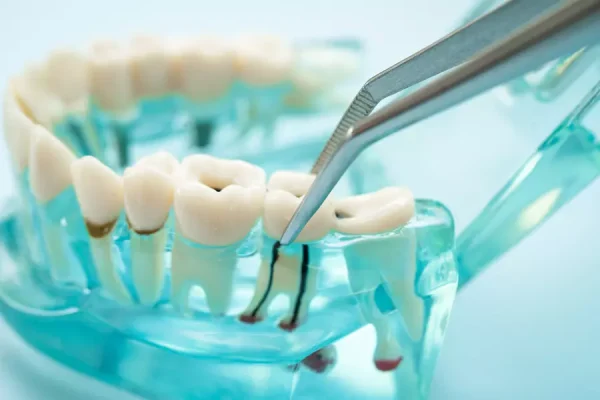 Professional teeth whitening treatment